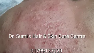 Acne treatment || Salipeel with Comedon extraction || Pores || Dr. Ummay Habiba Sumi || 01799123129