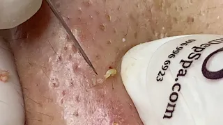 Blackheads And Pimples Hidden Under The Skin | Loại Bỏ Mụn Đầu Đen Và Mụn Ẩn - SacDepspa#248