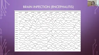 Вебінар на тему: "Клінічна ЕЕГ в діагностиці та моніторингу неврологічних і психічних захворювань"