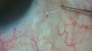 Injecting bevacizumab /ranibizumab into vitreous cavity - Pradip Mohanta