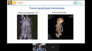 RACHIS FOETAL NORMAL ET PATHOLOGIQUE