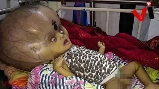 Baby With ‘World’s Largest Head’ Has Life Saving Surgery To Remove 8 Pounds Of Fluids From Skull