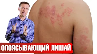 Опоясывающий лишай: что делать? Опоясывающий герпес 👉 симптомы, причины.