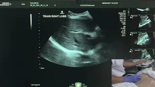 Ultrasound of the Right Liver Lobe