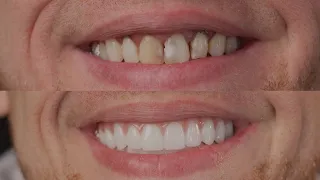 Dental Implant Journey / Teeth By Tonight Transformation / All on Four Dental Implants