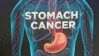 Baptist MD Anderson Cancer Center discusses stomach cancer signs, treatments