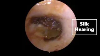 Ear Wax Removal