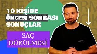 Saç Dökülmesine Çözüm: 10 kişide öncesi sonrası değerlendirme