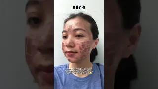 Progress after laser co2 Fractional | Review Indonesia