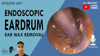 687 - Endoscopic Eardrum Ear Wax Removal