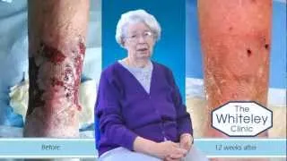 Leg ulcer healed at The Whiteley Clinic