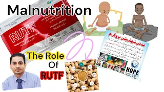 "Combatting Malnutrition: The Impact of RUTF" #malnutrition #Rutf