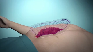 Aanbrengen van een Eakin Wound Pouch™ in 3 eenvoudige stappen (Dutch)