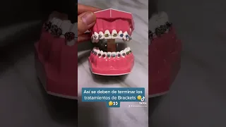 Así debe de terminar la mordida/sonrisa al finalizar un tratamiento de Brackets!! ☺️😀