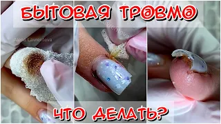 БЫТОВАЯ ТРАВМА/ ЧТО ДЕЛАТЬ? ТРАВМА НОГТЯ ЧТО ДЕЛАТЬ? СОРВАЛА НОГОТЬ ПОД КОРЕНЬ/ УШИБЛА ПАЛЕЦ НА РУКЕ