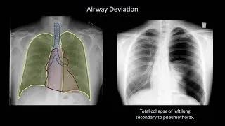 How to Interpret a Chest X-Ray (Lesson 4 - Airways, Bones, and Soft Tissues)