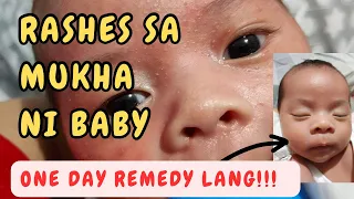 RASHES SA MUKHA ni baby| NEONATAL ACNE| REMEDY by Dr. Pedia Mom