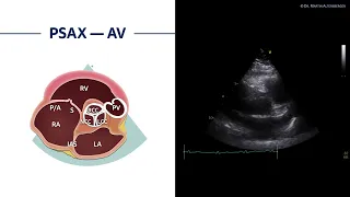 〖Echocardiography〗 Parasternal short axis view - AV anatomy 🫀📖