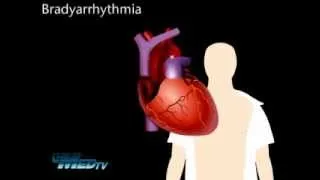 Bradyarrhythmia - Slow Heart Rhythm Overview
