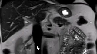 How to read an MRI of the abdomen | First Look MRI