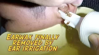 Hard Earwax Finally Removed by Ear Irrigation After 5 days of Ear wax Softener