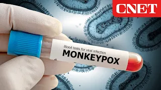 Monkeypox On The Rise: How to Stay Safe