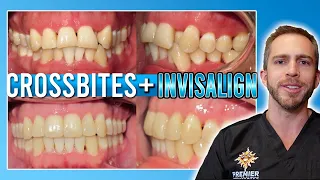 Invisalign Crossbite Treatment! [BEFORE & AFTER]