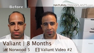 Hair Transplant Before and After | 8 Months Post Hair Transplantation (Valiant)