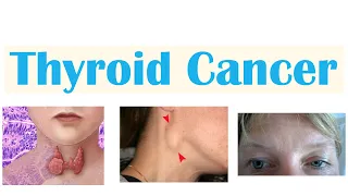 Thyroid Cancer (Papillary, Follicular, Medullary & Anaplastic) | Symptoms, Diagnosis, Treatment