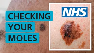 How do I check if my mole is skin cancer? | NHS