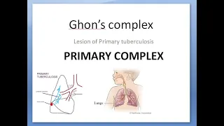 Pathology 158 a Ghon complex primary tuberculosis secondary lung focus children child miliary lesion