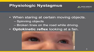 Nystagmus | A Patient Guide