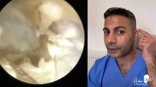 1,507 - Fully Blocked Infected Dead Skin Removal due to Otitis Externa