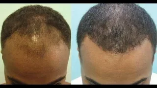 Try This Hair Loss Treatment To Stimulate Hair Regrowth