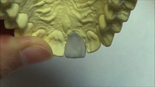 Live wax up - Upper central incisor