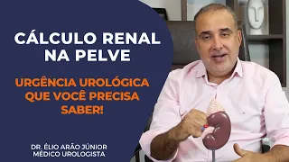 CÁLCULO RENAL NA PELVE - SINTOMAS E TRATAMENTOS | Dr. Élio Arão Júnior