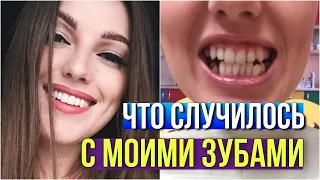 3 года ПОСЛЕ СНЯТИЯ БРЕКЕТОВ // ЧТО СЛУЧИЛОСЬ С МОИМИ ЗУБАМИ