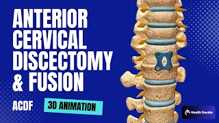 Anterior Cervical Discectomy and Fusion (ACDF) - 3D animation