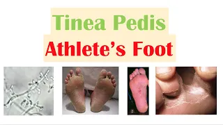 Athlete’s Foot (Tinea Pedis)| Causes, Risk Factors, Signs & Symptoms, Diagnosis and Treatment