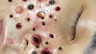 Big Cystic Acne Blackheads Extraction Blackheads & Milia, Whiteheads Removal Pimple Popping #134