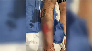 Man recovering from gator attack in North Port