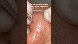 Extracting Large Blackheads Big Cystic Acne Blackheads&Whiteheads Removal Pimple Popping #162 #Short