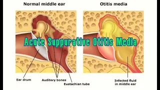 Acute Suppurative Otitis Media | Etiology, Pathophysiology, Clinical Feature & Management