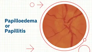 Papilloedema or Papillitis (Neuro Ophthalmology)