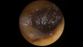 765 - Masses of Deep Dark Impacted Ear Wax Removal