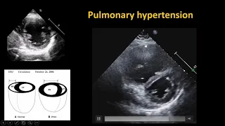 Borneo Point Of Care Ultrasound For Extubation Readiness Test