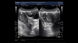 Ultrasound Video showing Endometrial hyperplasia in 33 years old female.