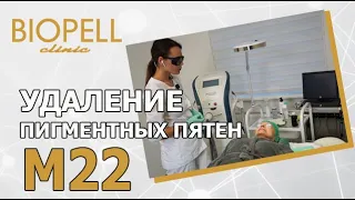 УДАЛЕНИЕ ПИГМЕНТНЫХ ПЯТЕН АППАРАТОМ M22