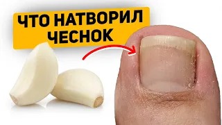 Как я мазала ногти чесноком и что произошло с грибком ногтей (важно знать)