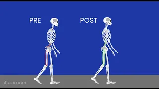 Training-induced changes in anterior pelvic tilt (by Mendiguchia J. et al.)